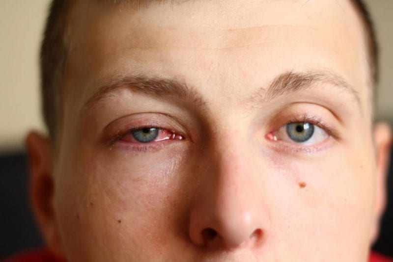 How to Get Rid of Pink Eye