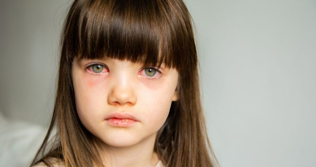 Can a Sinus Infection Cause Pink Eye?