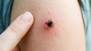 What Are the Early Signs of Lyme Disease Omaha Families Should Watch For?